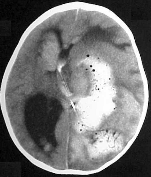 Choroid Plexus Carcinoma choroid-plexus-carcinoma